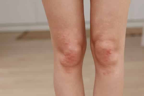 Dermatitis