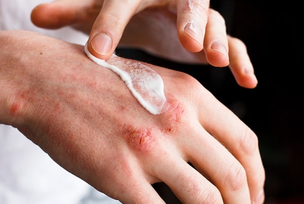 Dermatitis