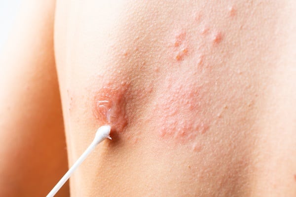 Shingles
