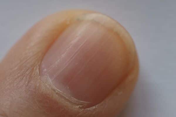 Nail Health