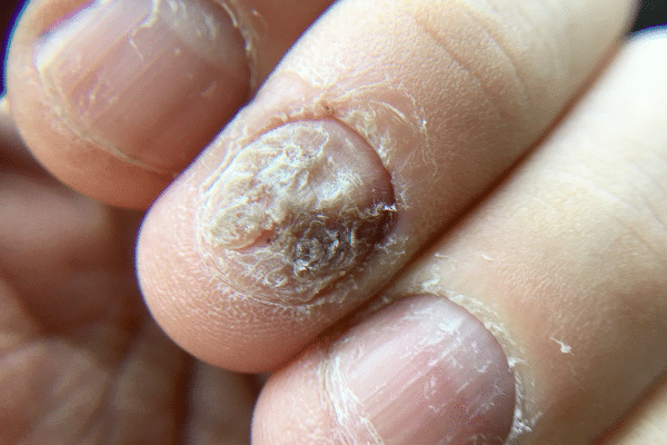 Nail Health