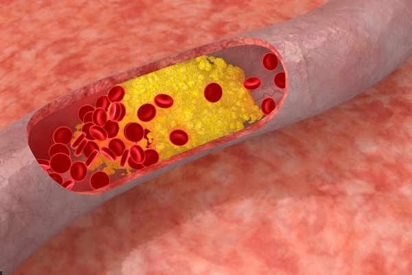 Risk of Ignoring High Cholesterol
