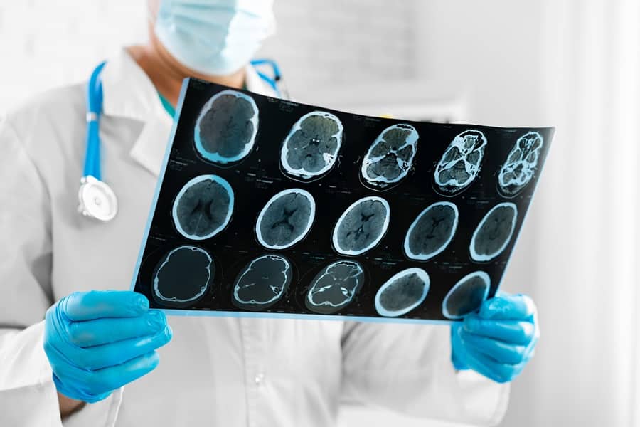 What Really Causes Strokes