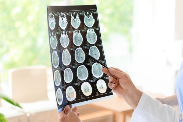 Risk of Alzheimer’s Disease