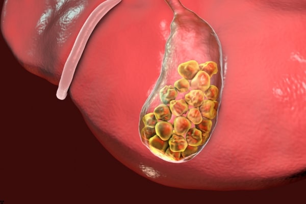 The Silent Threat of Gallstones
