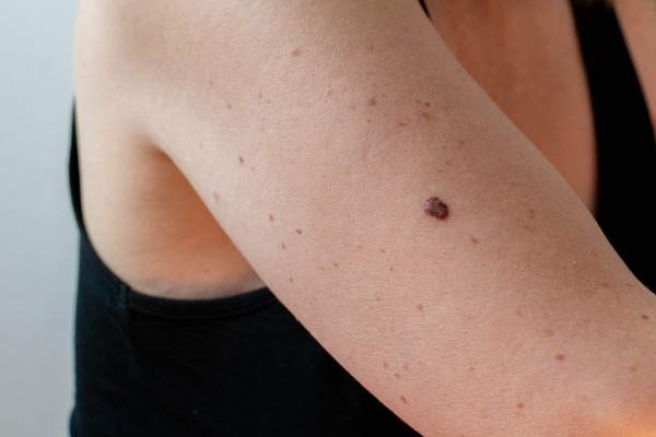 Cancer Signs Women Often Ignore