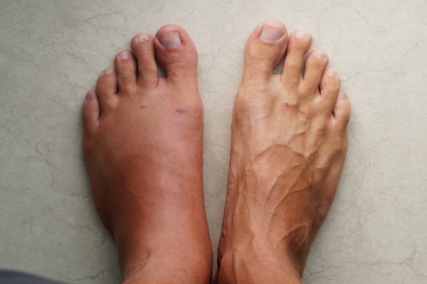 Signs of a Blood Clot